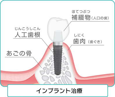 インプラント治療とは