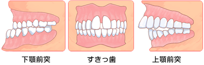 下顎前突・すきっ歯・上顎前突