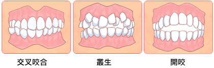 交互咬合・叢生・開咬